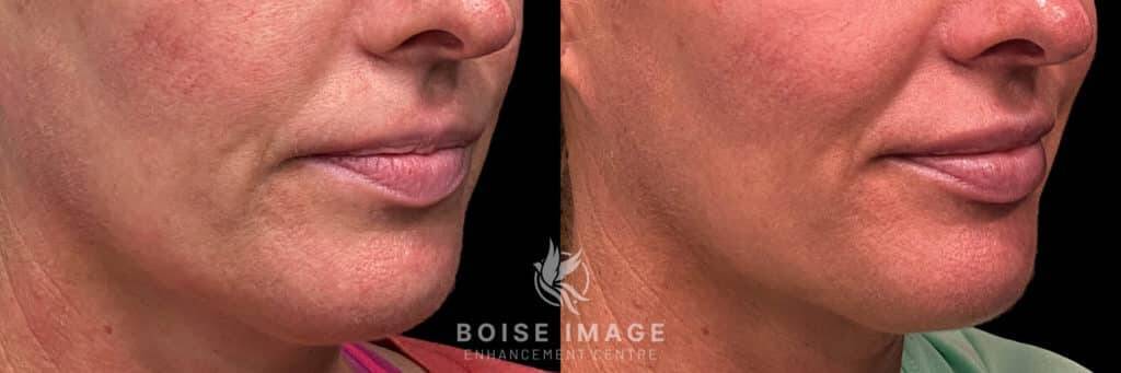 Volbella Lip Filler Before and After
