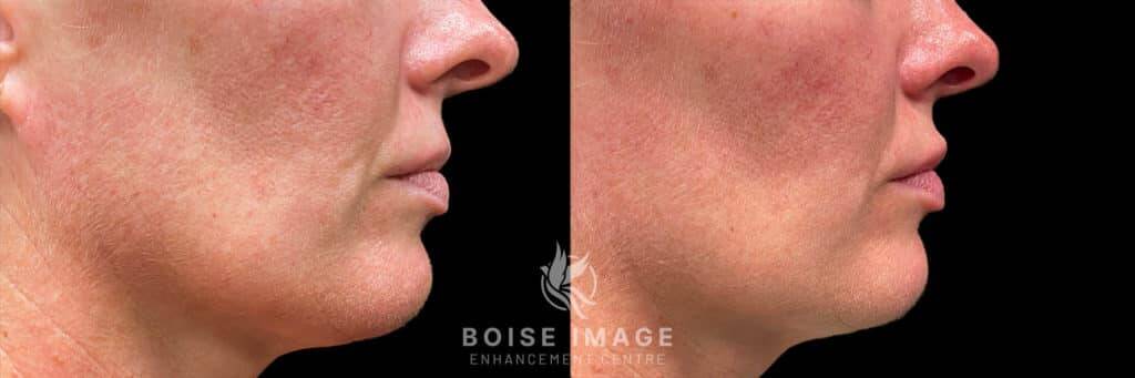 Volbella Lip Filler Before and After