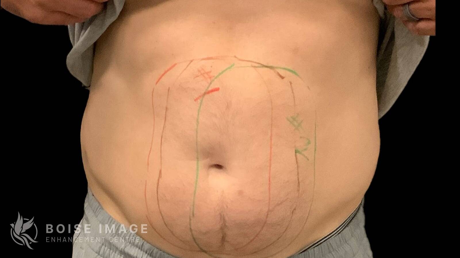 Abdomen Before