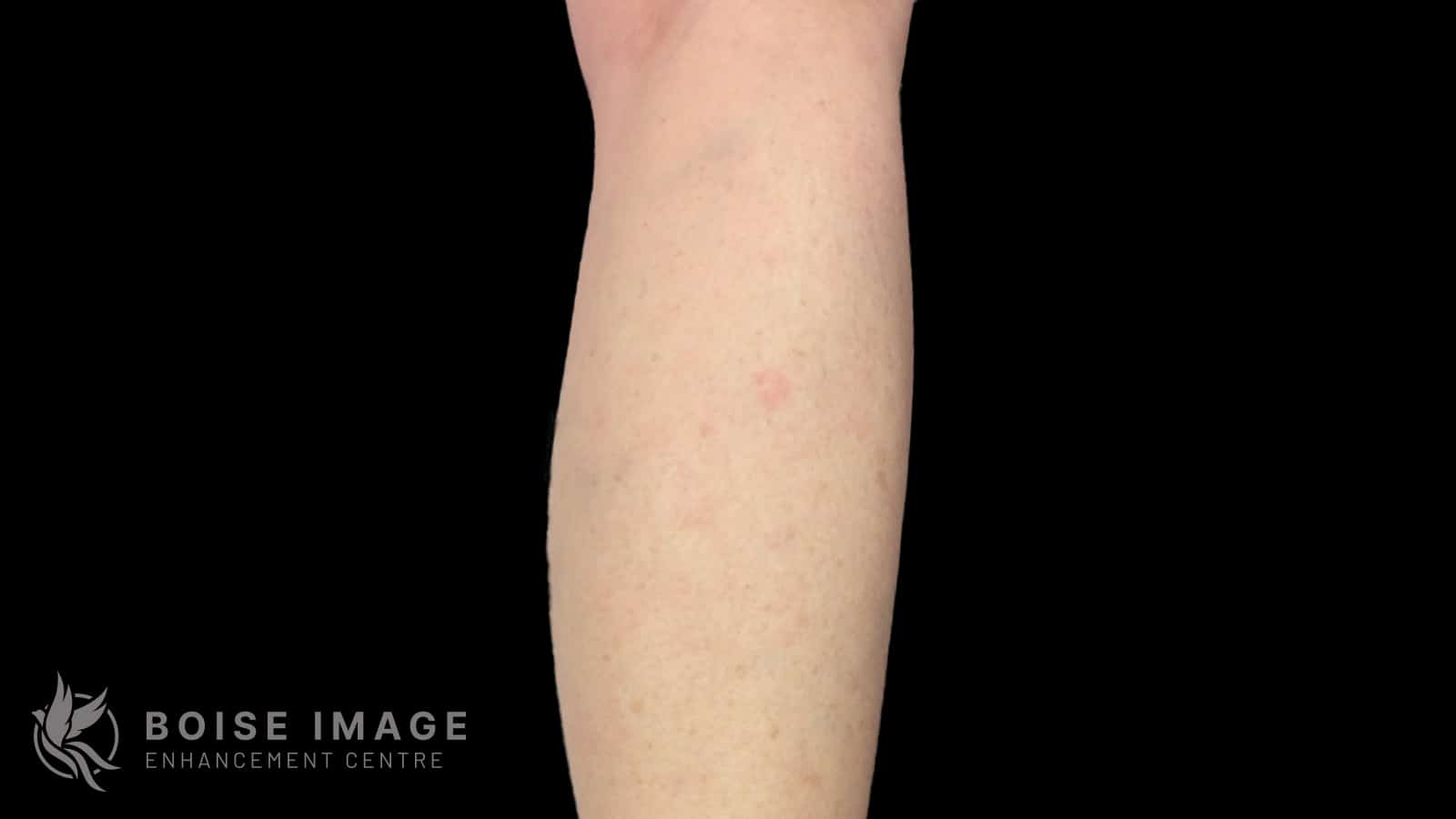 Anterior Thigh After