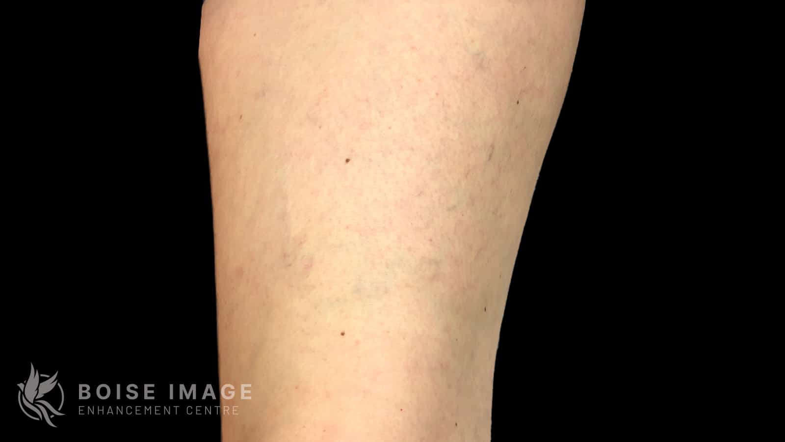 Anterior Thigh After