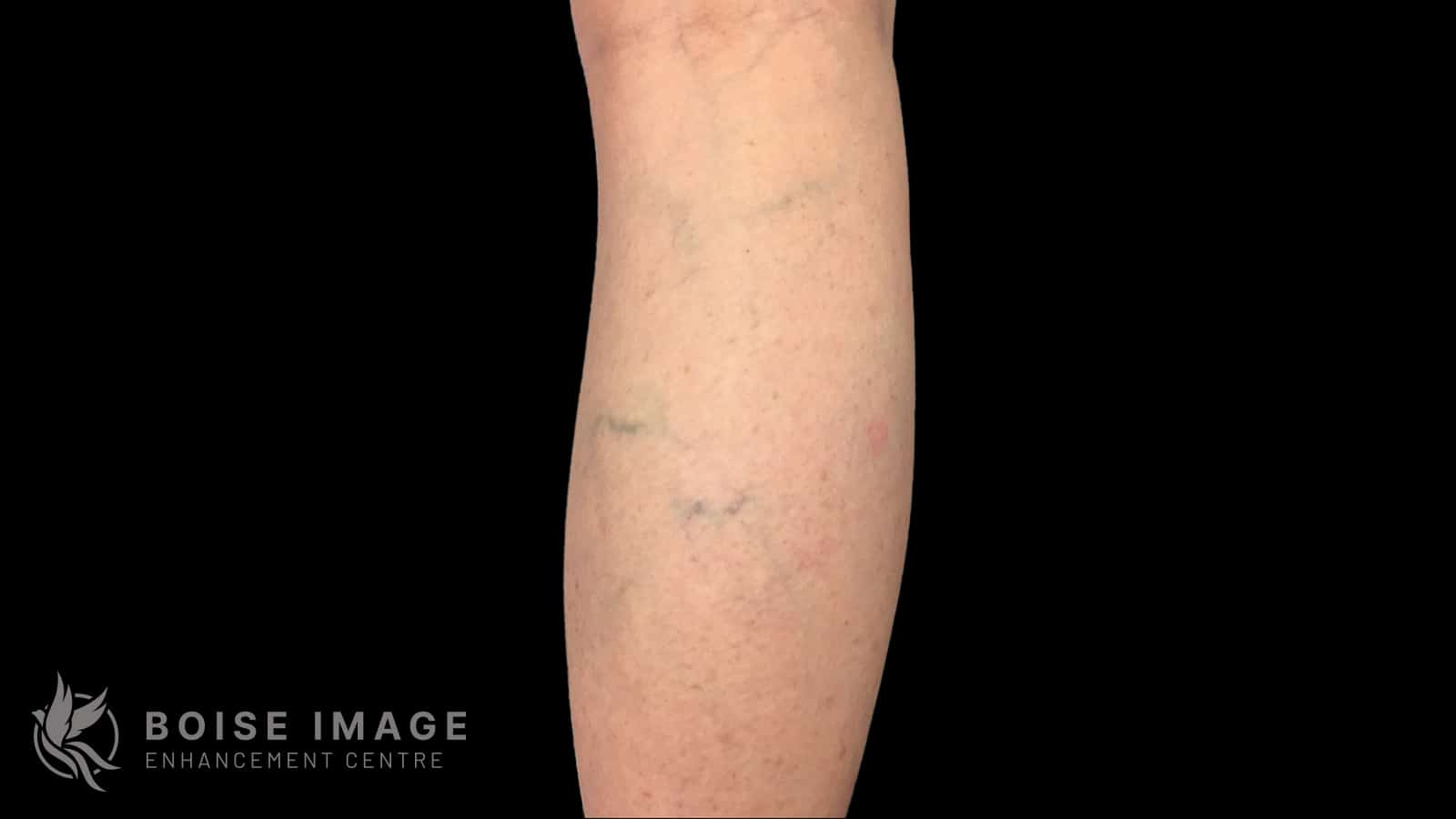 Anterior Thigh Before