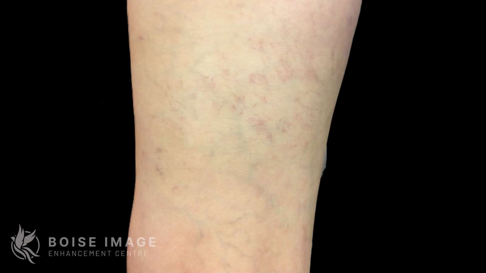 Anterior Thigh Before