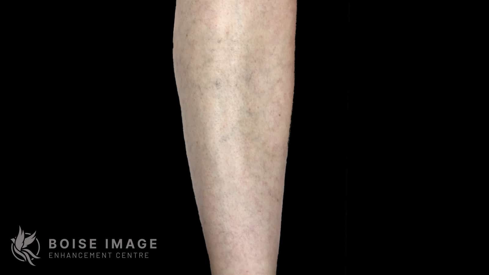 Anterior Thigh Before