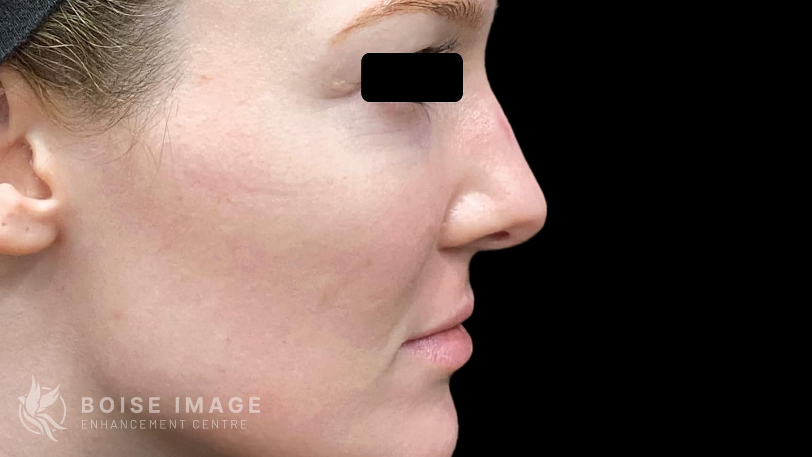 Cheek Pop After