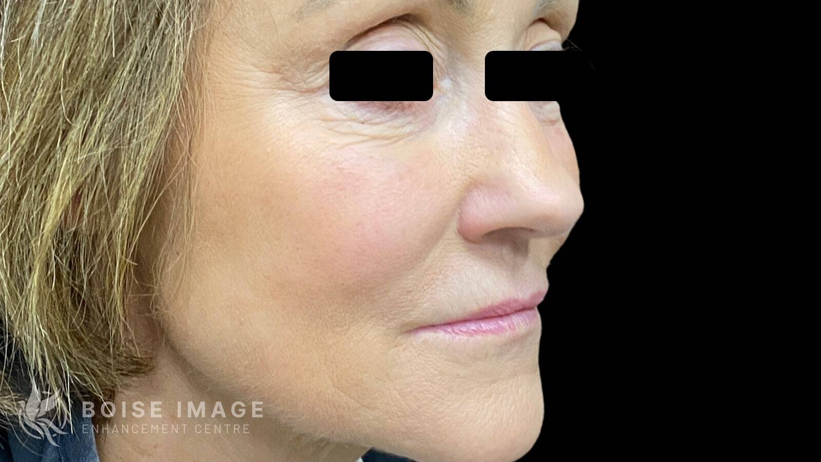 Cheek Pop After