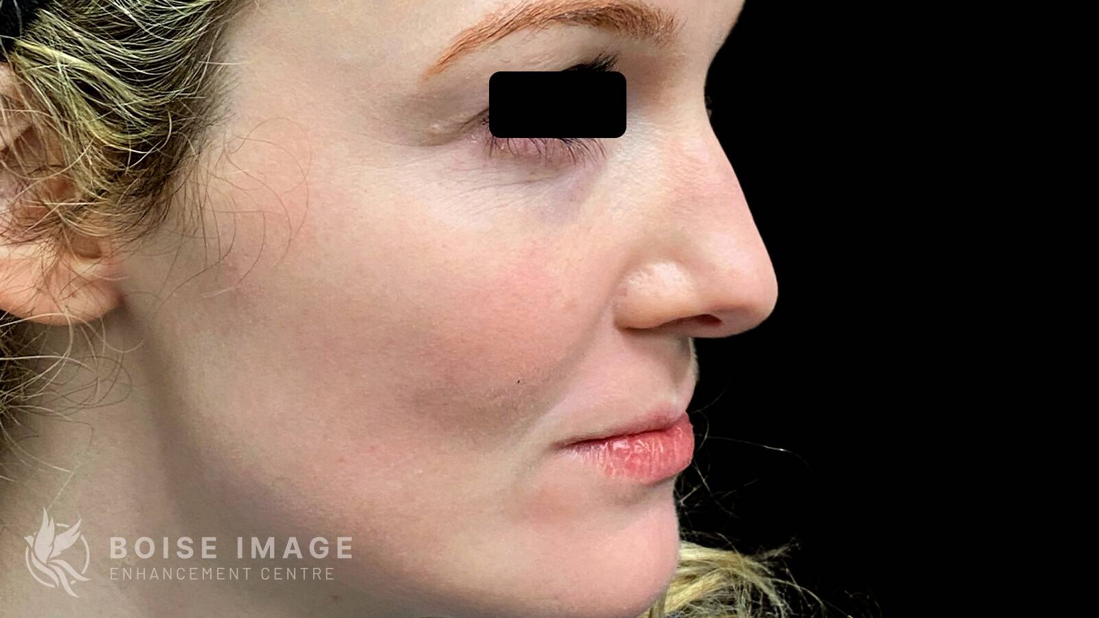 Cheek Pop Before