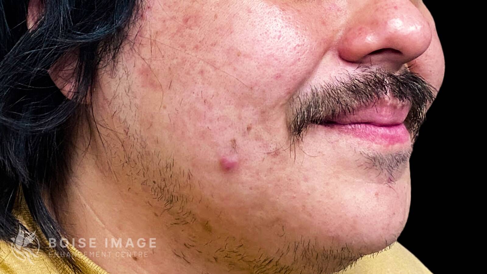 Cheeks After
