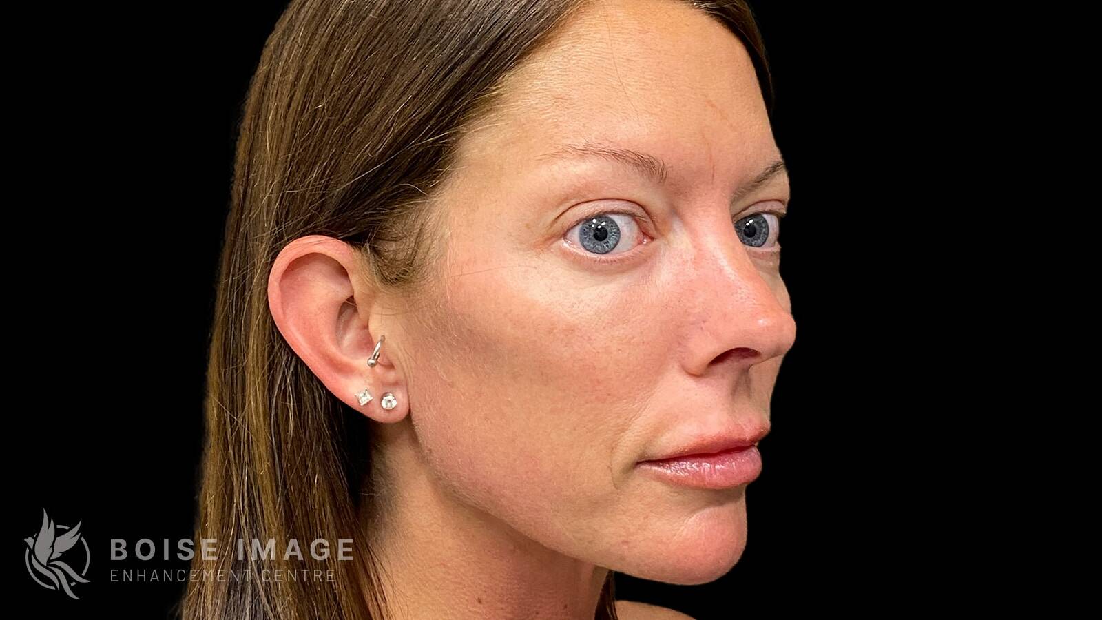 Cheeks After