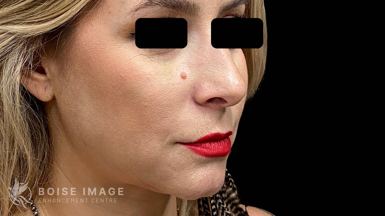 Cheeks After
