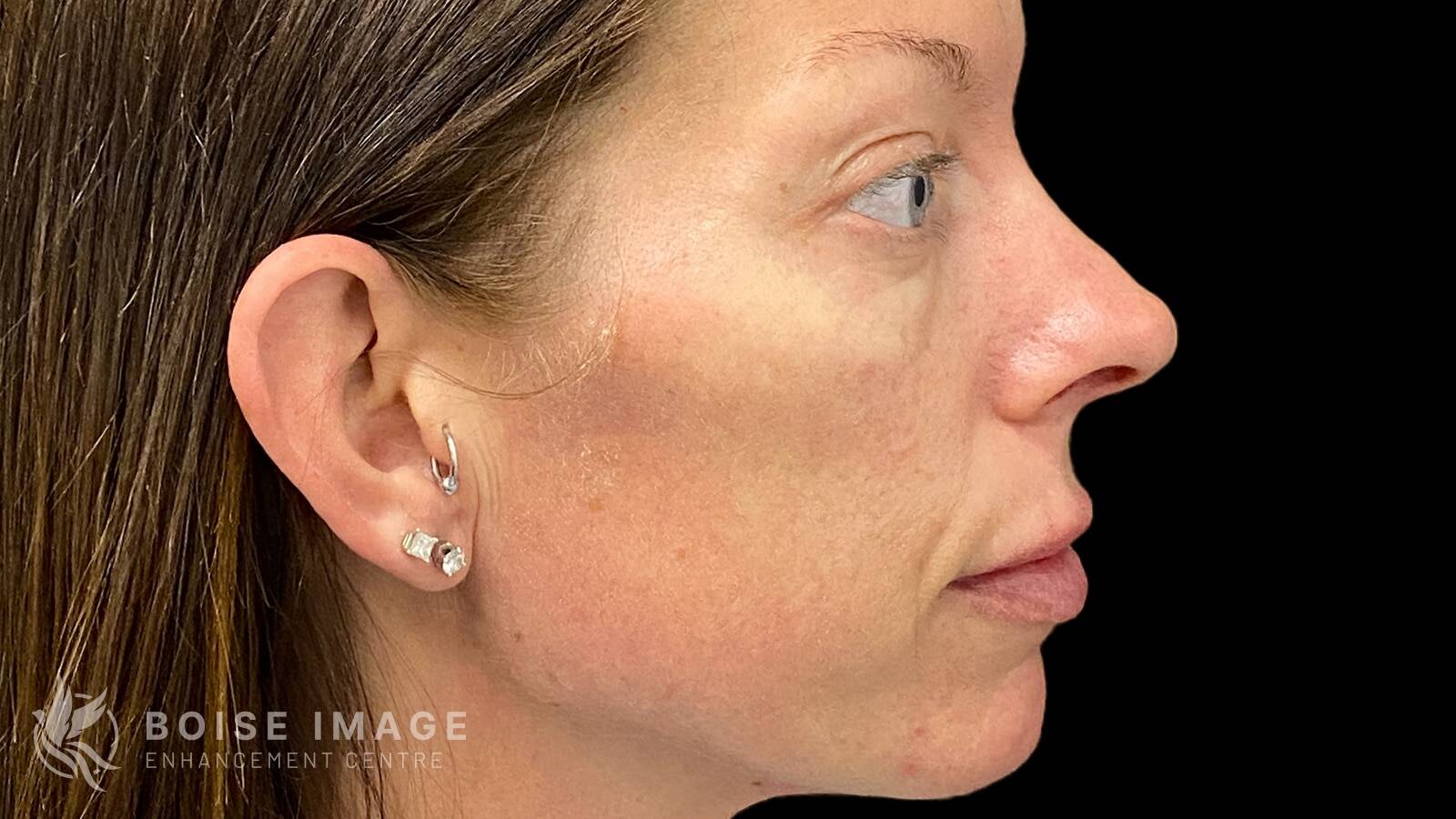 Cheeks Before