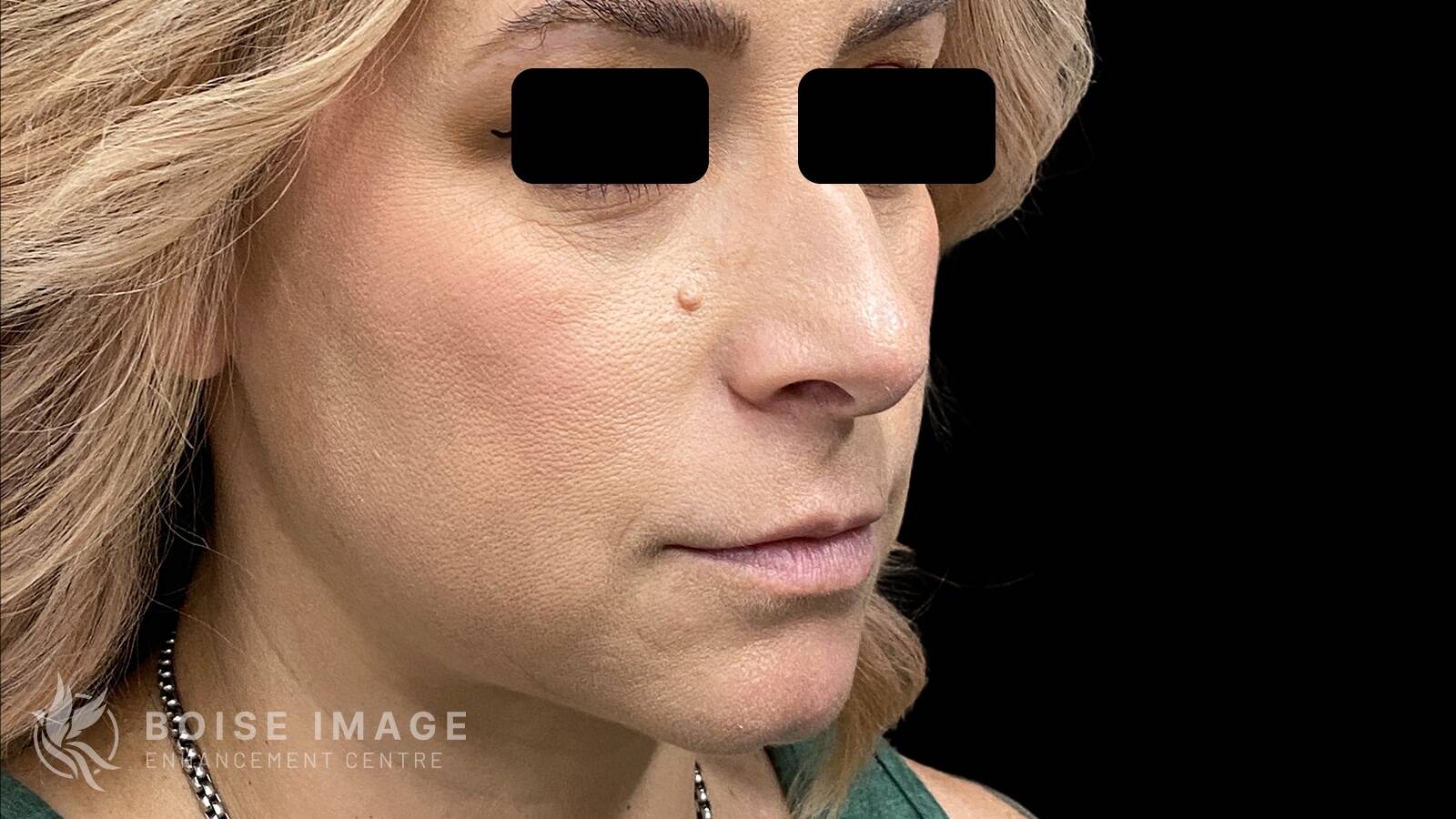 Cheeks Before