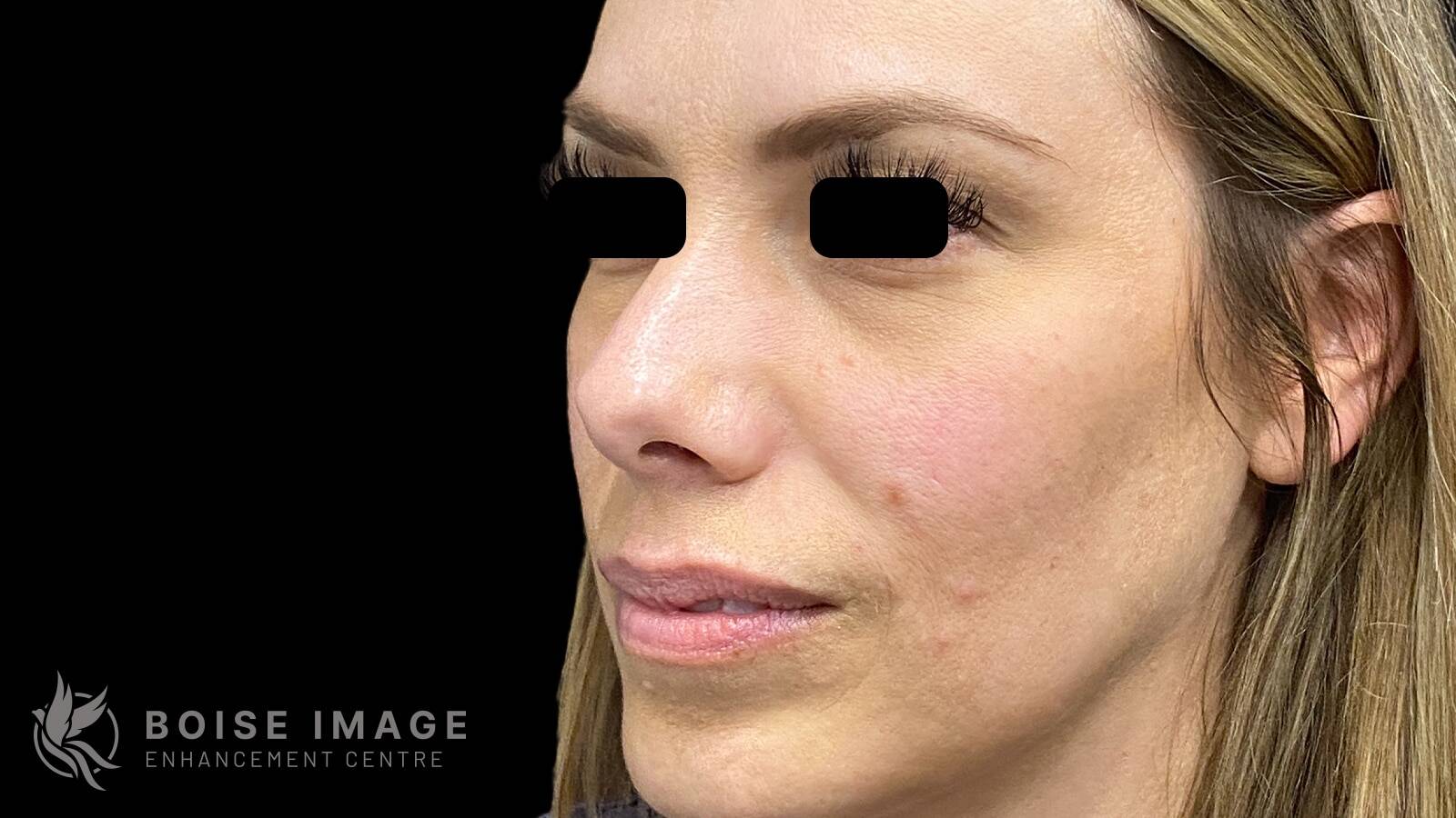 Cheeks and Under Eyes Before