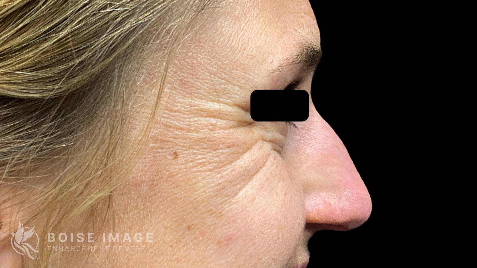 Crows Feet Before