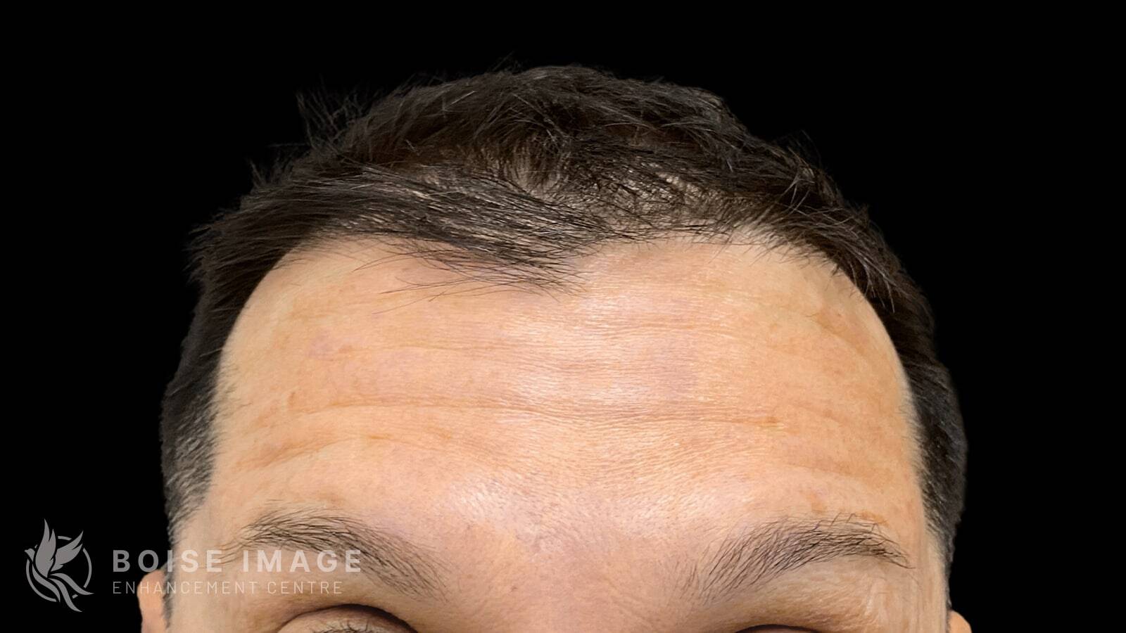 Forehead After