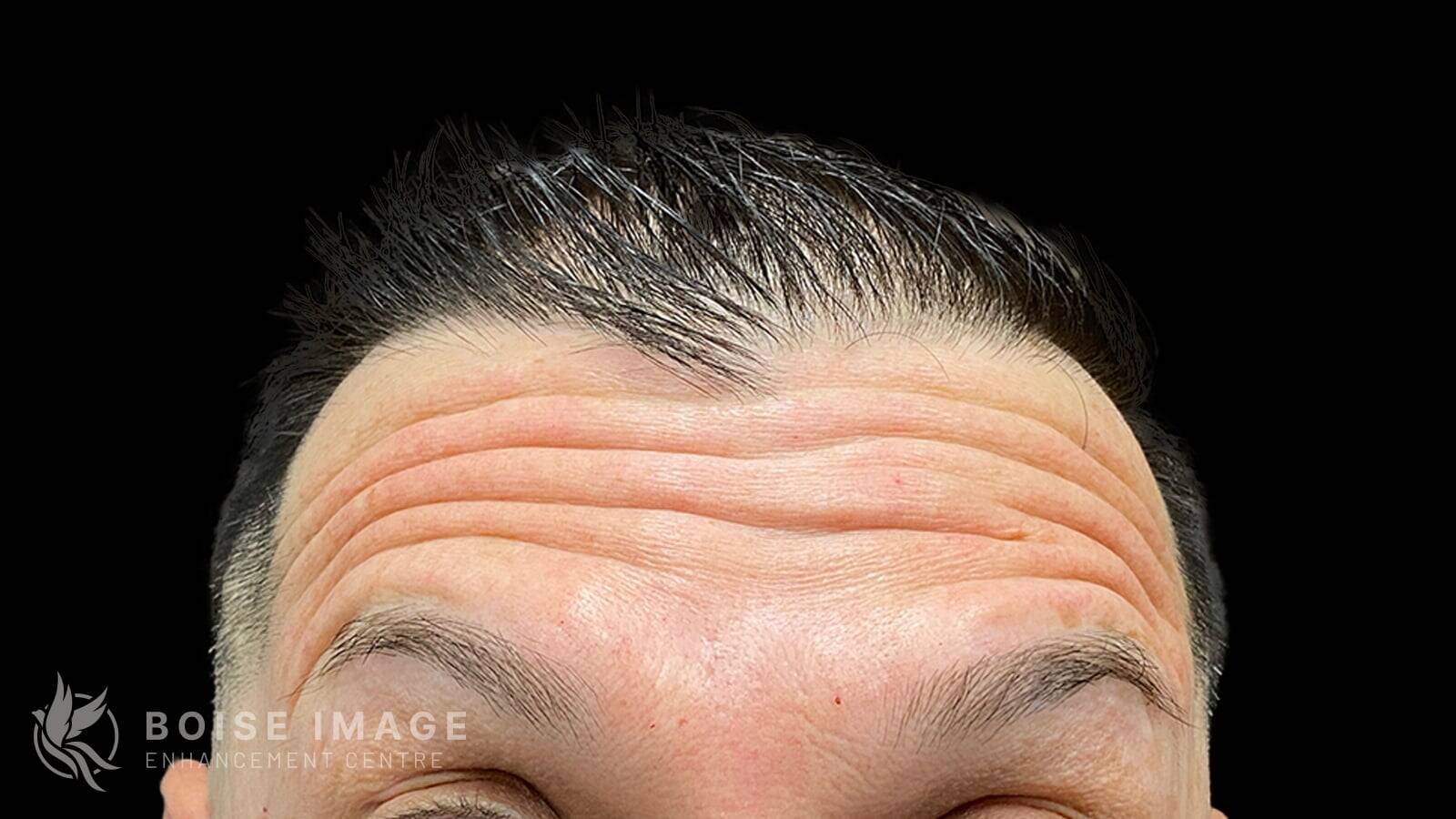 Forehead Before