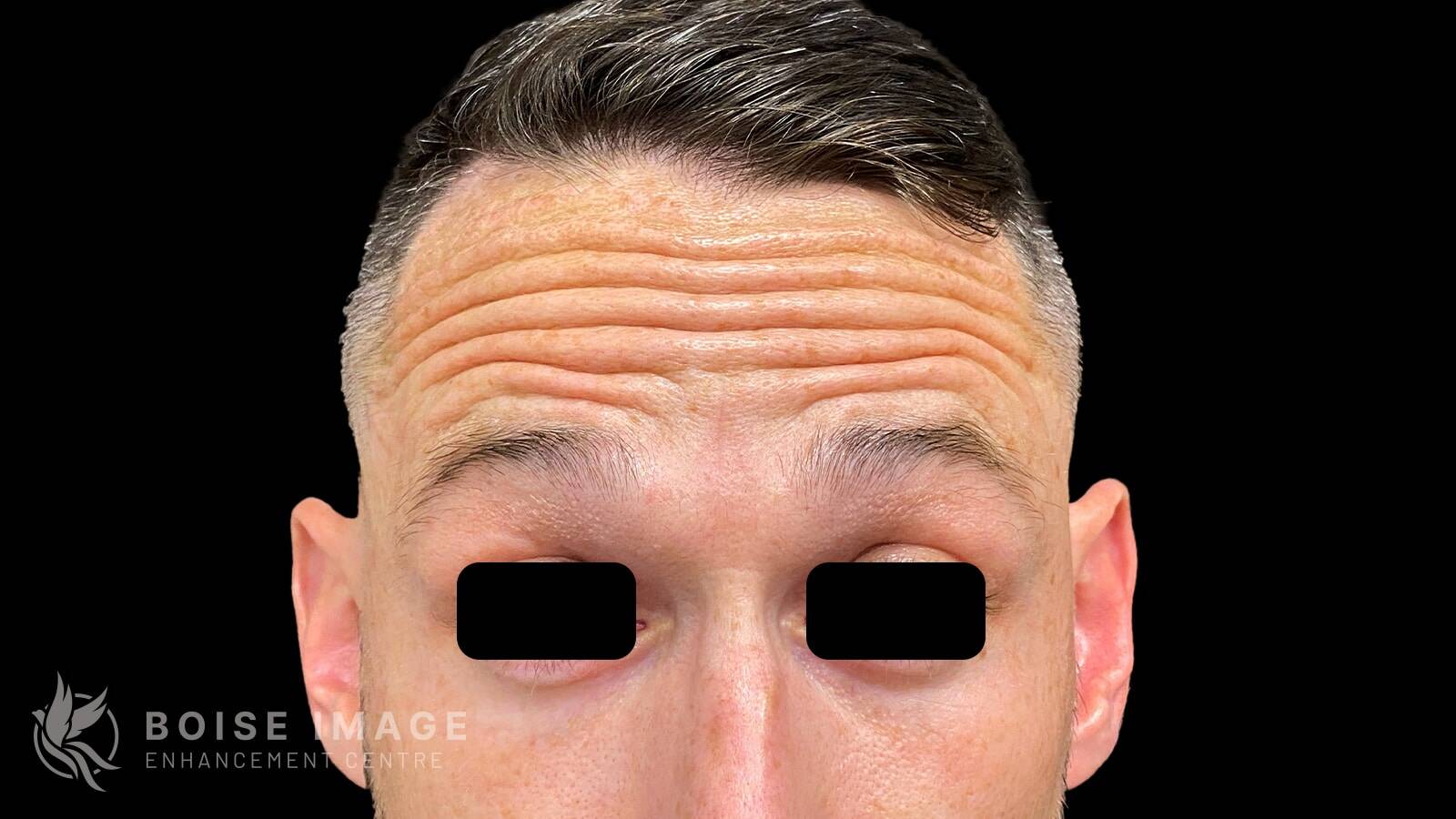 Forehead Before