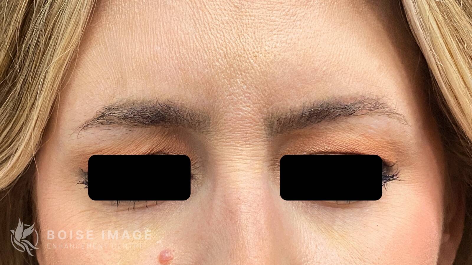 Glabella After