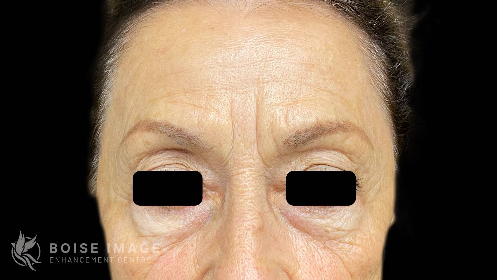 Glabella Before