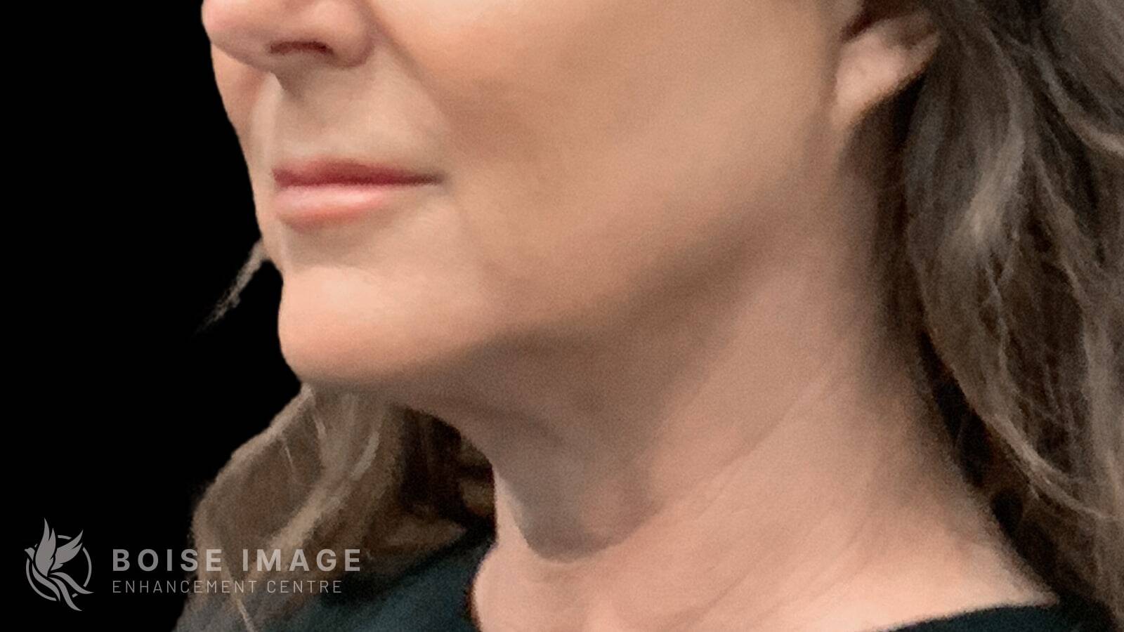 Jawline Chin After