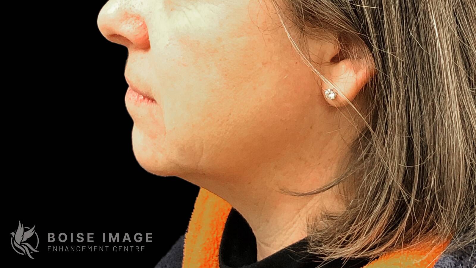 Kybella After