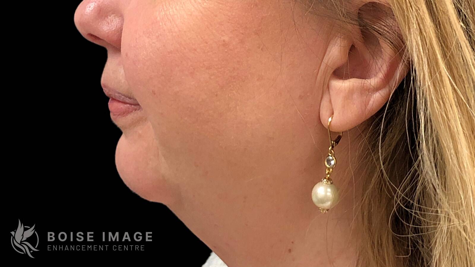 Kybella After