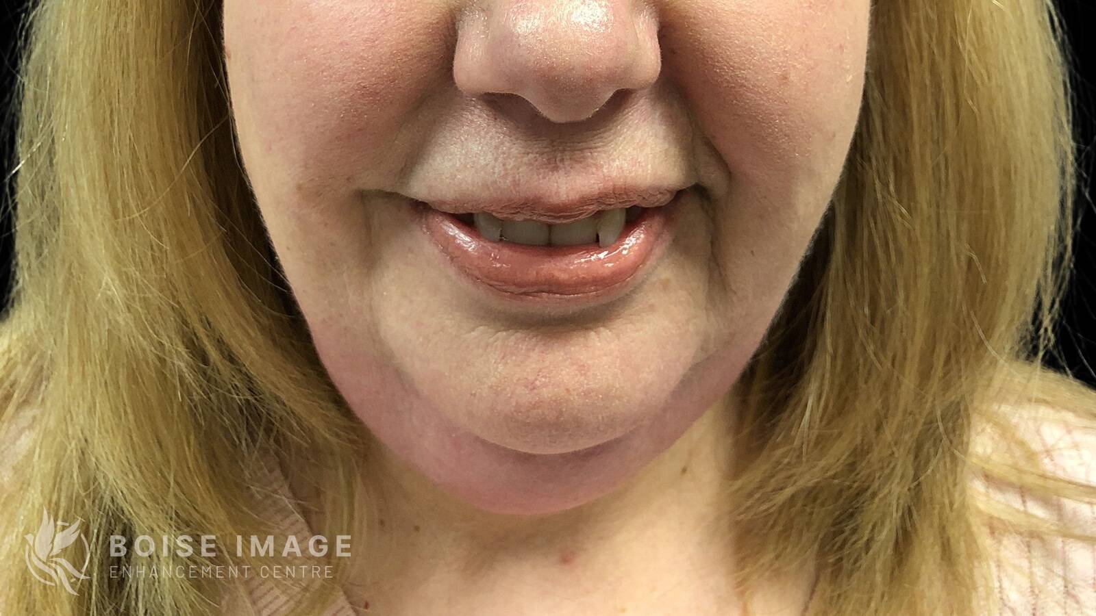 Kybella Before