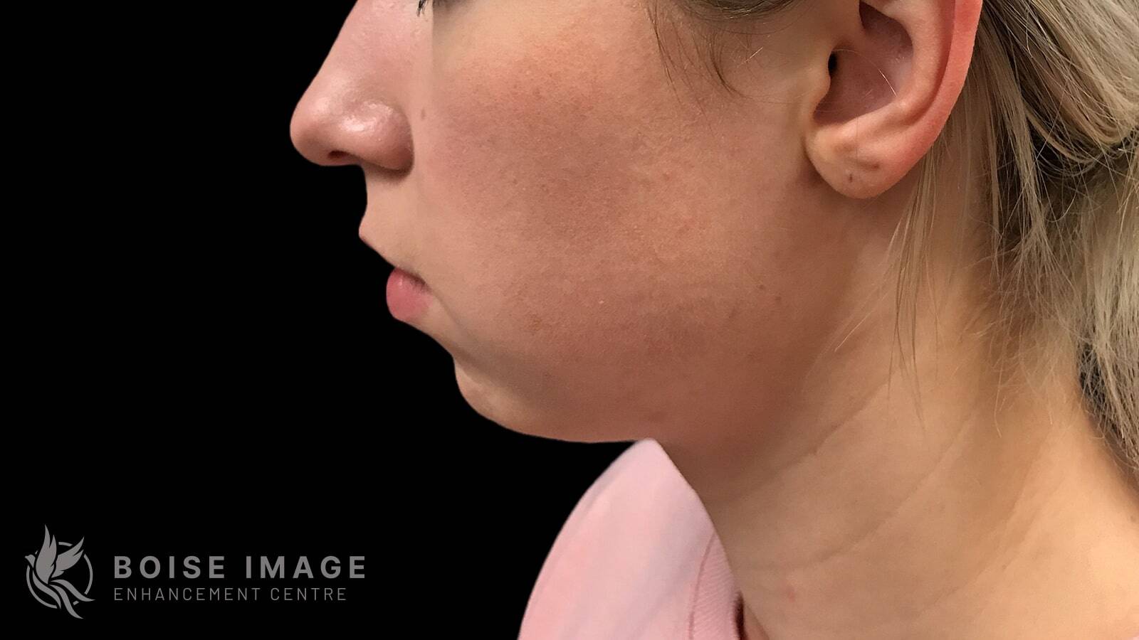 Kybella Before