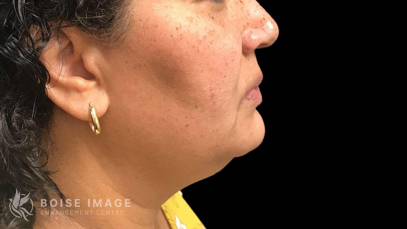 Kybella Before