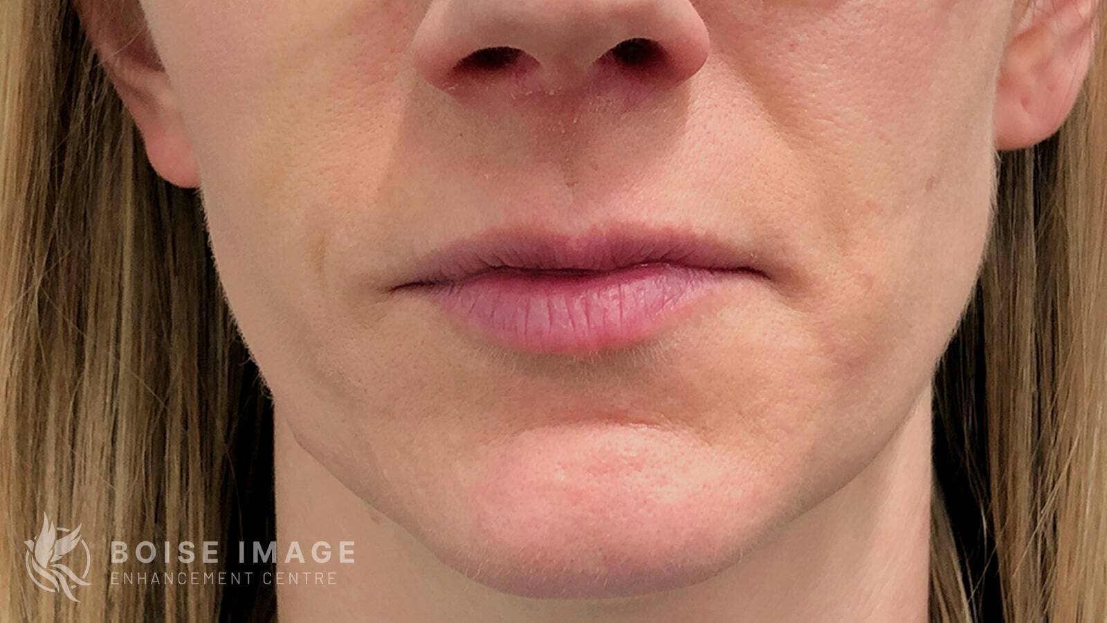 Lips After