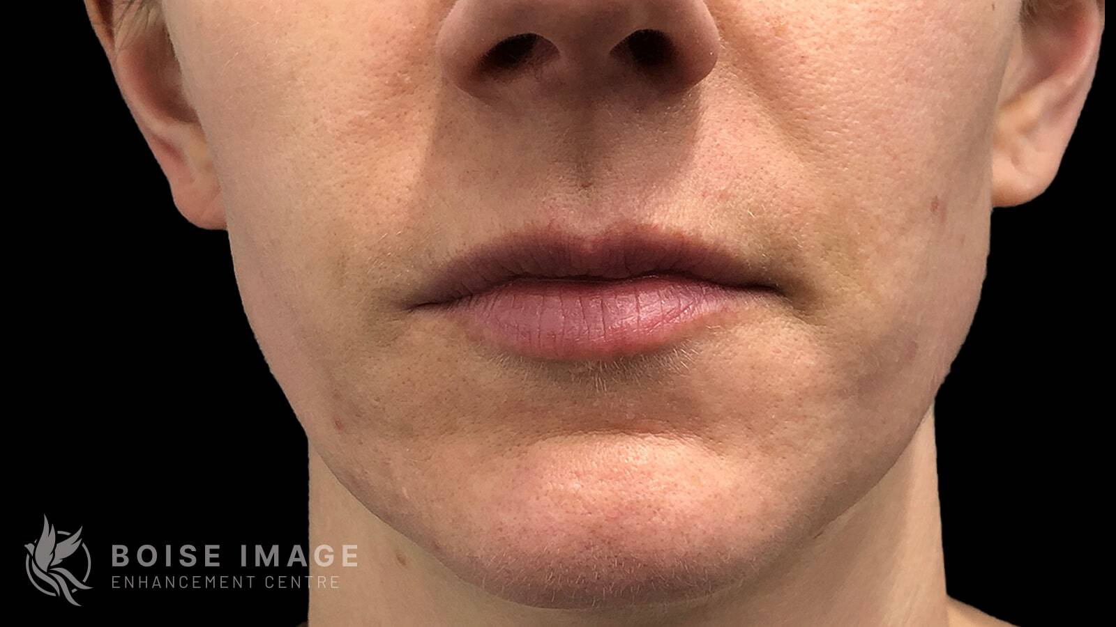 Lips Before