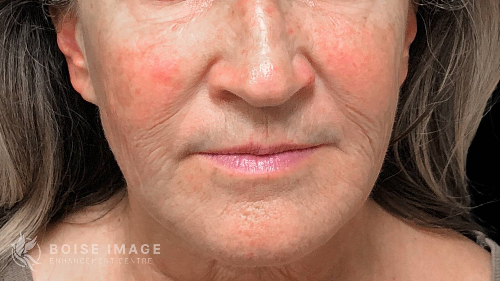 Lower Face After