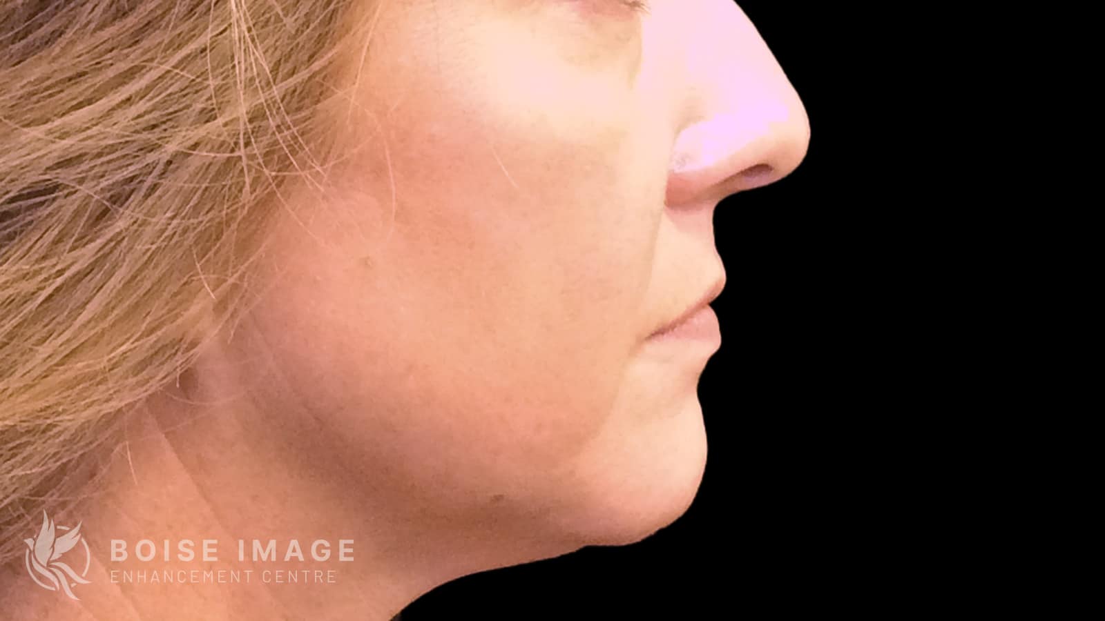 Lower Face After