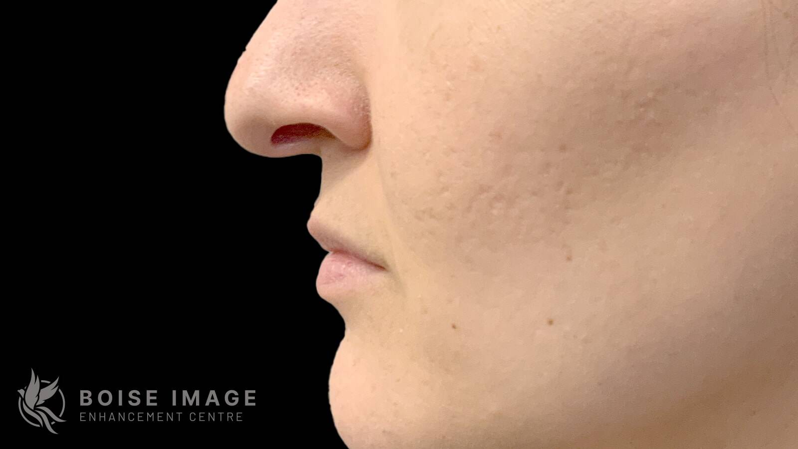 Lower Face Before
