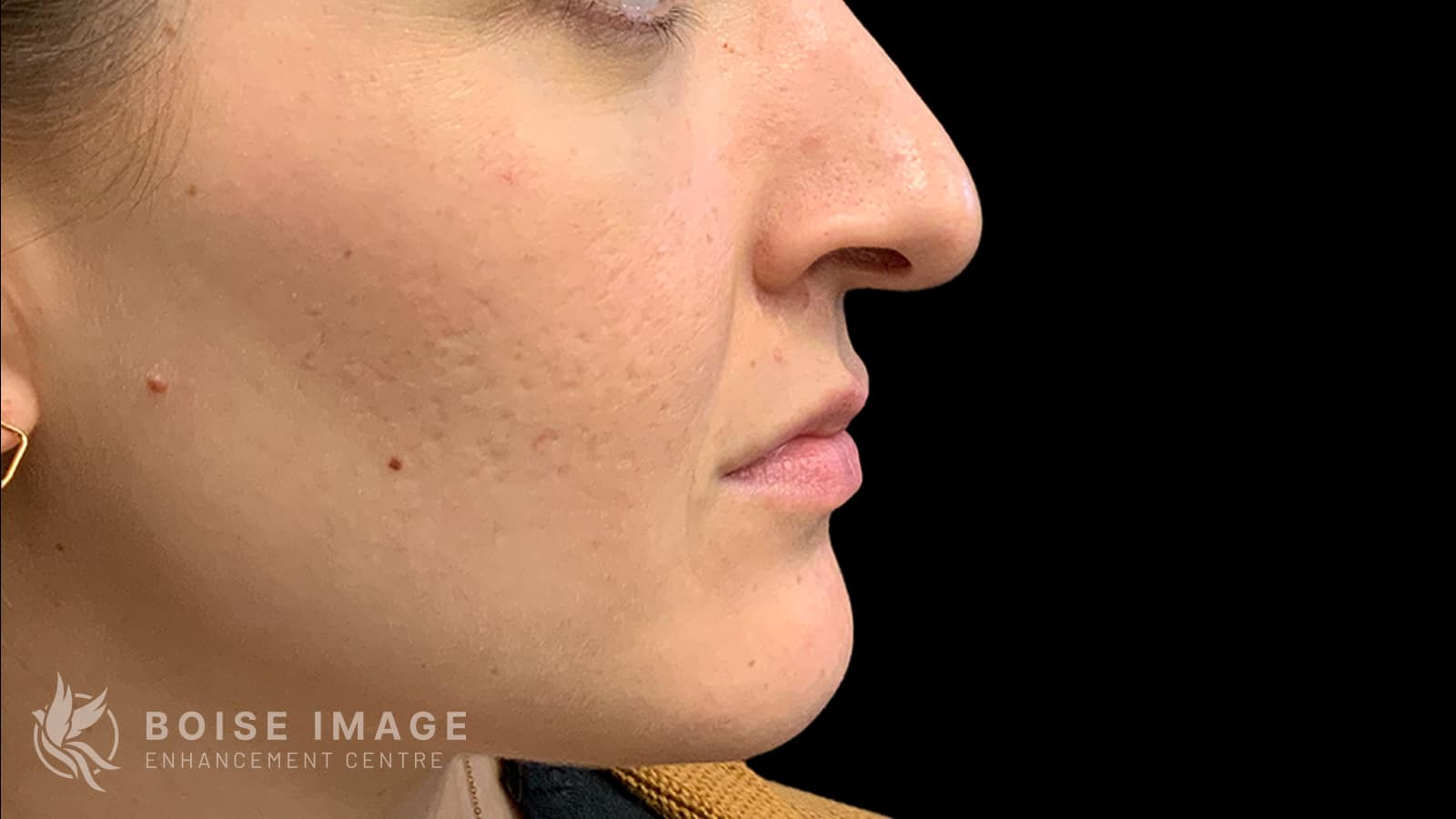 Lower Face Before