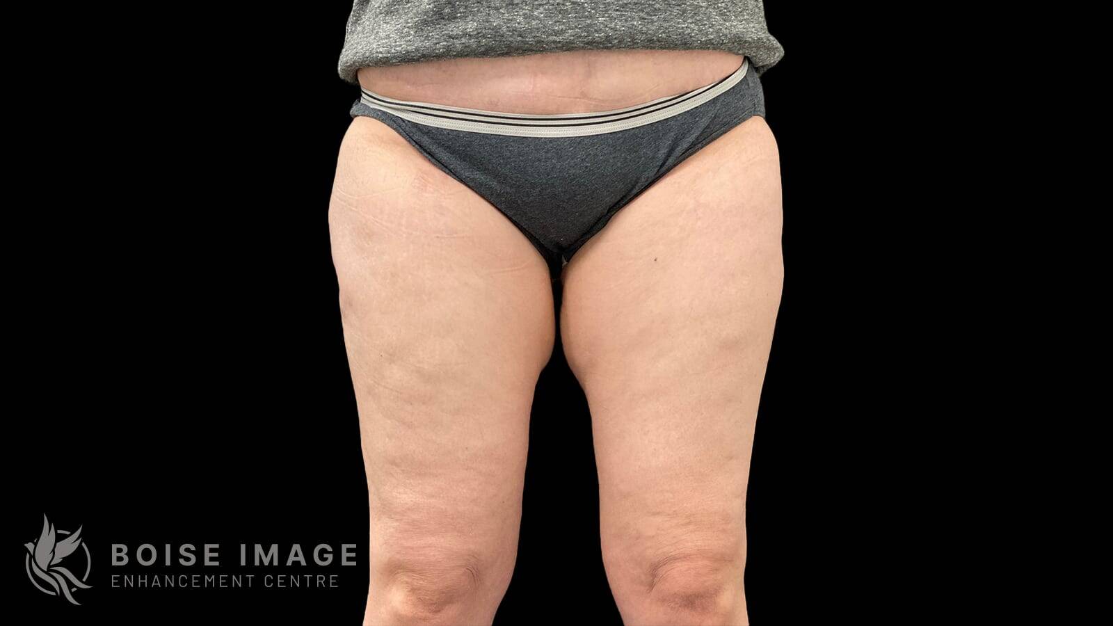 Outer Thighs After
