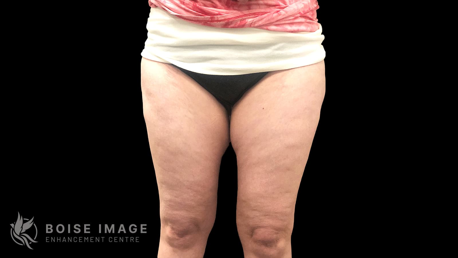 Outer Thighs Before