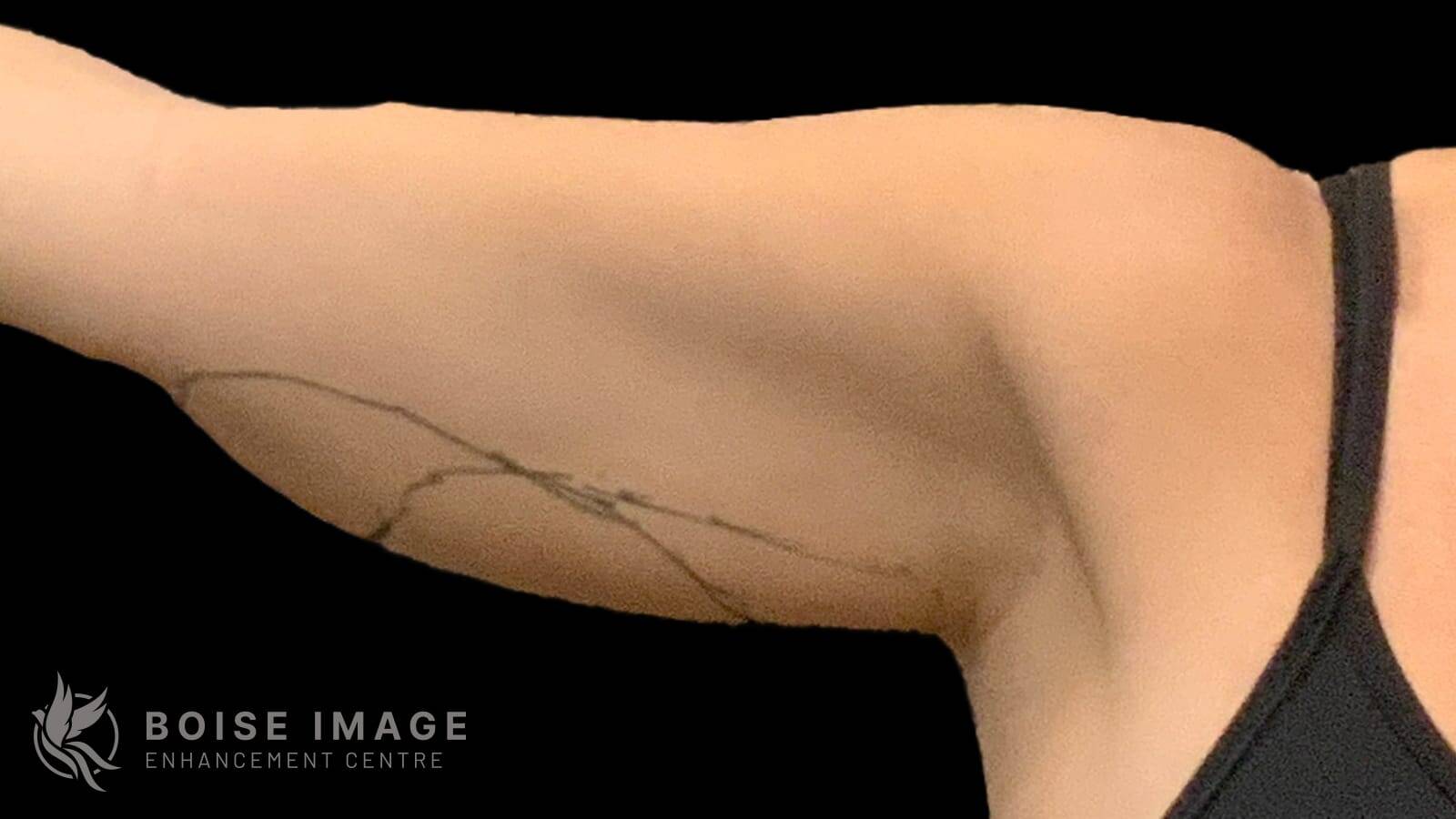 Right Arm Before