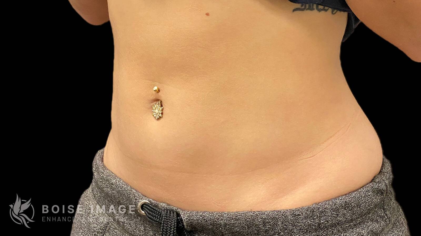 Stomach After