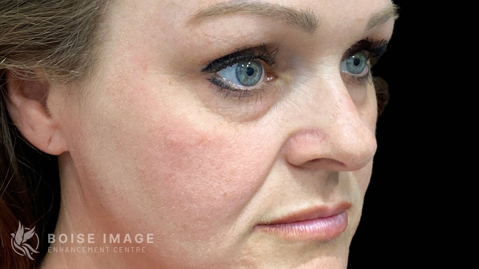 Under Eyes Before