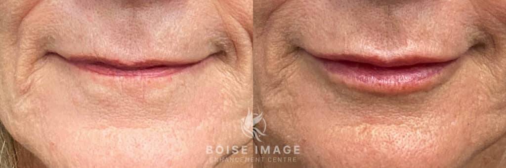 Before and after pictures of Restylane Kysse Lip Filler