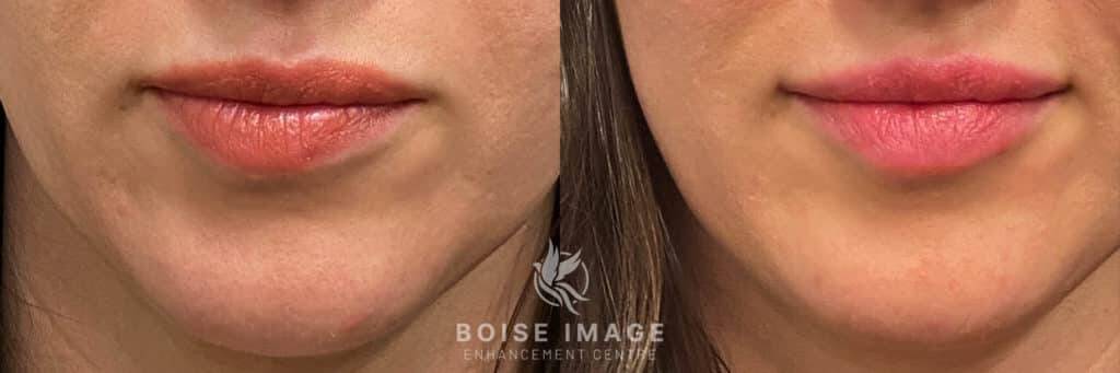 Restylane Kiss Before & After Picture