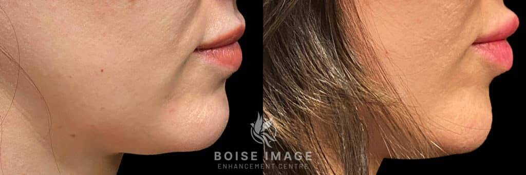 Restylane Kiss Before and After