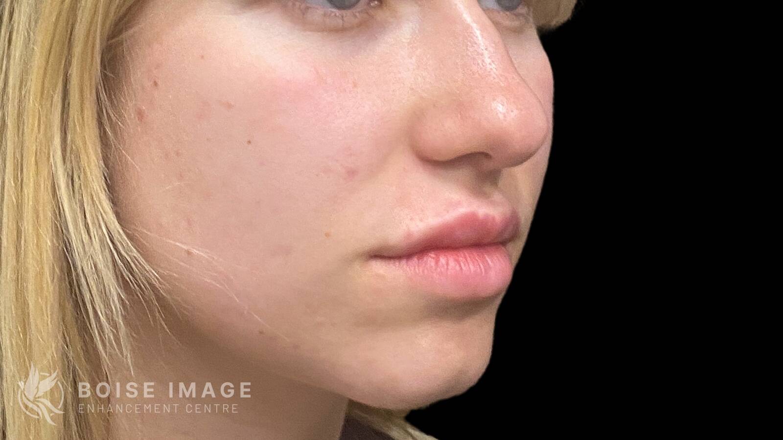 Lips After