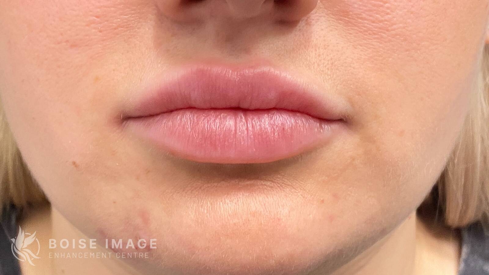 Lips After