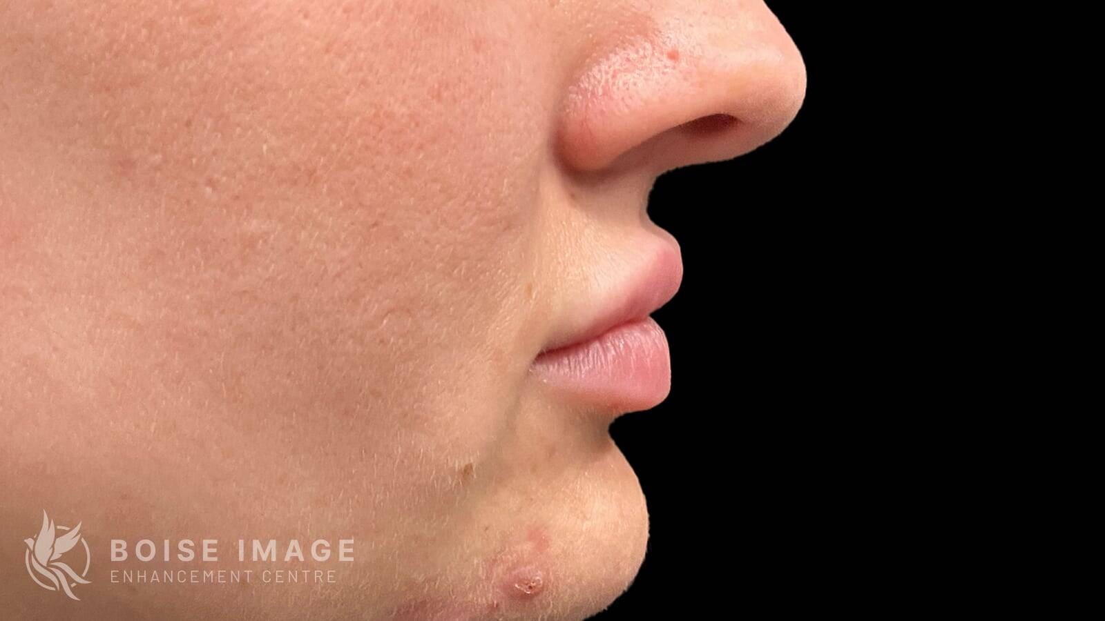 Lips After