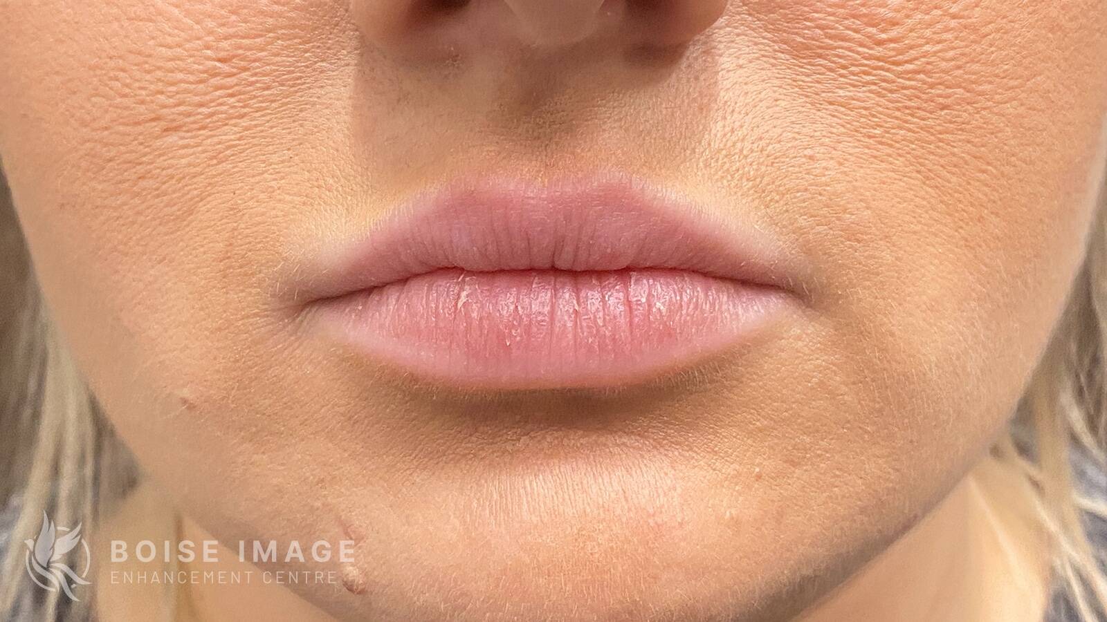 Lips Before