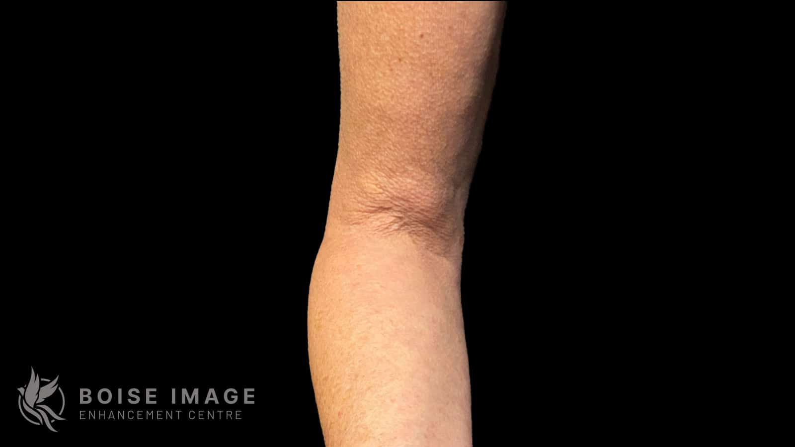 Right Arm After